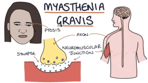 6 Cara Mencegah Terjadinya Myasthenia gravis